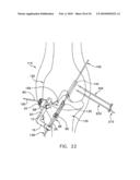 METHOD AND APPARATUS FOR FIXING A GRAFT IN A BONE TUNNEL diagram and image