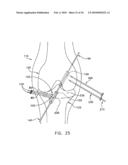 METHOD AND APPARATUS FOR FIXING A GRAFT IN A BONE TUNNEL diagram and image