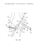 METHOD AND APPARATUS FOR FIXING A GRAFT IN A BONE TUNNEL diagram and image