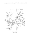 METHOD AND APPARATUS FOR FIXING A GRAFT IN A BONE TUNNEL diagram and image