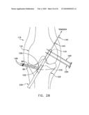 METHOD AND APPARATUS FOR FIXING A GRAFT IN A BONE TUNNEL diagram and image