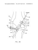 METHOD AND APPARATUS FOR FIXING A GRAFT IN A BONE TUNNEL diagram and image