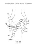 METHOD AND APPARATUS FOR FIXING A GRAFT IN A BONE TUNNEL diagram and image