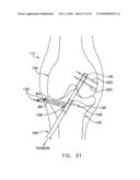 METHOD AND APPARATUS FOR FIXING A GRAFT IN A BONE TUNNEL diagram and image