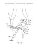 METHOD AND APPARATUS FOR FIXING A GRAFT IN A BONE TUNNEL diagram and image