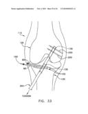 METHOD AND APPARATUS FOR FIXING A GRAFT IN A BONE TUNNEL diagram and image