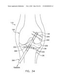 METHOD AND APPARATUS FOR FIXING A GRAFT IN A BONE TUNNEL diagram and image