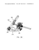 METHOD AND APPARATUS FOR FIXING A GRAFT IN A BONE TUNNEL diagram and image