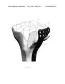 Periarticular Bone Plate With Biplanar Offset Head Member diagram and image