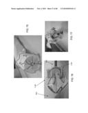 Dual Capture Device for Stent Graft Delivery System and Method for Capturing a Stent Graft diagram and image