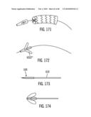 Dual Capture Device for Stent Graft Delivery System and Method for Capturing a Stent Graft diagram and image