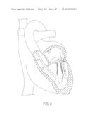 Apparatus for Treating a Heart Valve, in Particular a Mitral Valve diagram and image