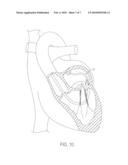 Apparatus for Treating a Heart Valve, in Particular a Mitral Valve diagram and image