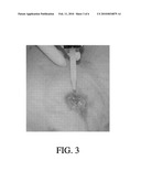 HYALURONIC ACID PRODUCT AND METHOD FOR TREATING LACERATIONS AND WOUNDS IN A LIVING BODY diagram and image