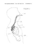 Methods and apparatus for transesophageal microaccess surgery diagram and image