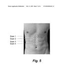 DEVICE, SYSTEM AND METHOD TO MEASURE ABDOMINAL AORTIC ANEURYSM DIAMETER diagram and image