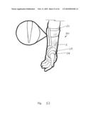 Orthopaedic Devices diagram and image