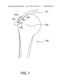 Suture-Retaining Device and Anchor diagram and image