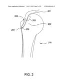 Suture-Retaining Device and Anchor diagram and image