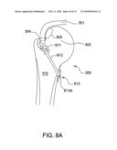 Suture-Retaining Device and Anchor diagram and image