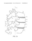 METHODS AND SYSTEMS FOR INCREASING THE BENDING STIFFNESS AND CONSTRAINING THE SPREADING OF A SPINAL SEGMENT diagram and image