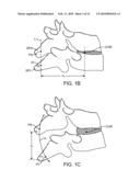 METHODS AND SYSTEMS FOR INCREASING THE BENDING STIFFNESS AND CONSTRAINING THE SPREADING OF A SPINAL SEGMENT diagram and image