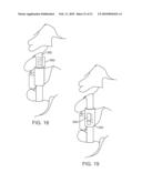 METHODS AND SYSTEMS FOR INCREASING THE BENDING STIFFNESS AND CONSTRAINING THE SPREADING OF A SPINAL SEGMENT diagram and image