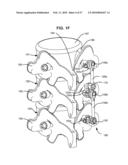 LOAD-SHARING BONE ANCHOR HAVING A DEFLECTABLE POST AND METHOD FOR STABILIZATION OF THE SPINE diagram and image