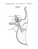 LOAD-SHARING BONE ANCHOR HAVING A DEFLECTABLE POST AND METHOD FOR STABILIZATION OF THE SPINE diagram and image