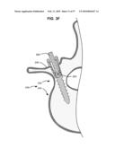 LOAD-SHARING BONE ANCHOR HAVING A DEFLECTABLE POST AND METHOD FOR STABILIZATION OF THE SPINE diagram and image