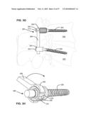 LOAD-SHARING BONE ANCHOR HAVING A DEFLECTABLE POST AND METHOD FOR STABILIZATION OF THE SPINE diagram and image