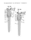 LOAD-SHARING BONE ANCHOR HAVING A DEFLECTABLE POST AND METHOD FOR STABILIZATION OF THE SPINE diagram and image