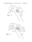 Bone end (Epiphysis) fracture fixation device and method of use diagram and image