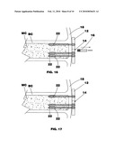 Bone end (Epiphysis) fracture fixation device and method of use diagram and image