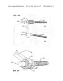 LOAD-SHARING BONE ANCHOR HAVING A DEFLECTABLE POST WITH A COMPLIANT RING AND METHOD FOR STABILIZATION OF THE SPINE diagram and image