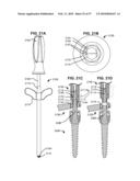 LOAD-SHARING BONE ANCHOR HAVING A DEFLECTABLE POST WITH A COMPLIANT RING AND METHOD FOR STABILIZATION OF THE SPINE diagram and image