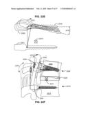 LOAD-SHARING BONE ANCHOR HAVING A DEFLECTABLE POST WITH A COMPLIANT RING AND METHOD FOR STABILIZATION OF THE SPINE diagram and image