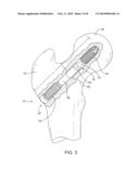 COLLAPSIBLE BONE SCREW APPARATUS diagram and image