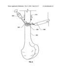 Methods for electrosurgical electrolysis diagram and image