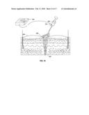 Methods for electrosurgical electrolysis diagram and image