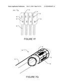 TRANSVASCULAR NERVE STIMULATION APPARATUS AND METHODS diagram and image