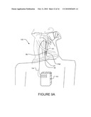 TRANSVASCULAR NERVE STIMULATION APPARATUS AND METHODS diagram and image