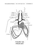 TRANSVASCULAR NERVE STIMULATION APPARATUS AND METHODS diagram and image