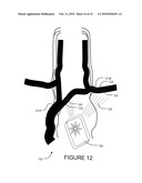 TRANSVASCULAR NERVE STIMULATION APPARATUS AND METHODS diagram and image