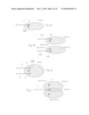 Systems and methods to place one or more leads in muscle for providing electrical stimulation to treat pain diagram and image