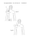 Systems and methods to place one or more leads in muscle for providing electrical stimulation to treat pain diagram and image