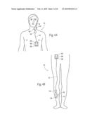 Systems and methods to place one or more leads in muscle for providing electrical stimulation to treat pain diagram and image