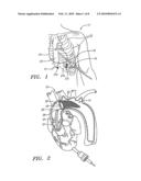 METHOD AND ASSEMBLY FOR DISTAL EMBOLIC PROTECTION diagram and image
