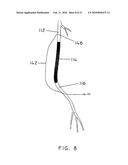 METHODS AND APPARATUS FOR EXTRALUMINAL FEMOROPOPLITEAL BYPASS GRAFT diagram and image