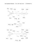 METHODS AND APPARATUS FOR EXTRALUMINAL FEMOROPOPLITEAL BYPASS GRAFT diagram and image